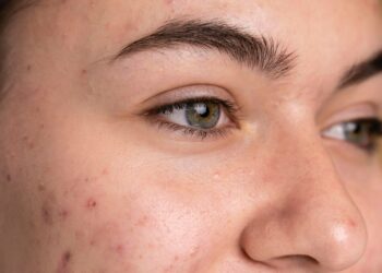 acne adulta