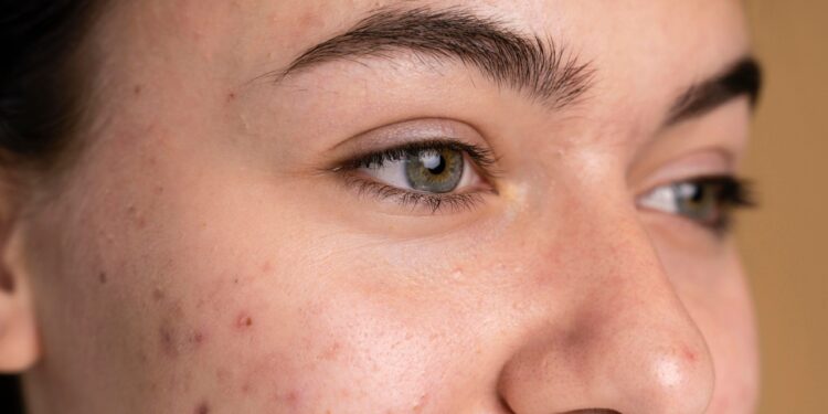 acne adulta