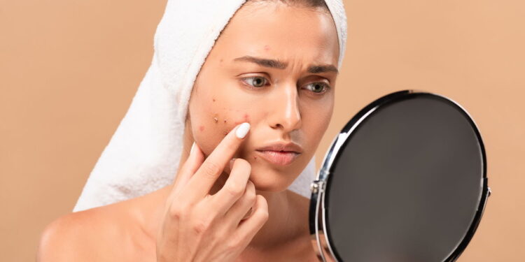 Como usar maquiagem sem piorar a acne