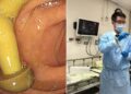 cogumelo no intestino