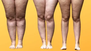 como tratar o lipedema no inverno