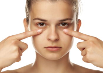 As melhores soluções naturais para acabar com as olheiras
