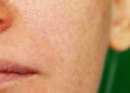 O tratamento mais eficaz para poros abertos segundo dermatologistas