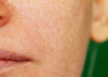 O tratamento mais eficaz para poros abertos segundo dermatologistas