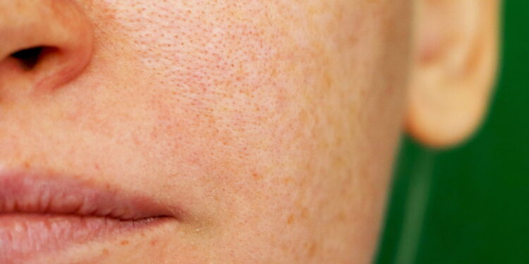 O tratamento mais eficaz para poros abertos segundo dermatologistas