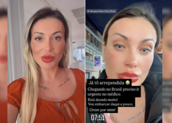 Procedimento para mudar a cor dos olhos é perigoso! Imagem: Instagram Andressa Urach