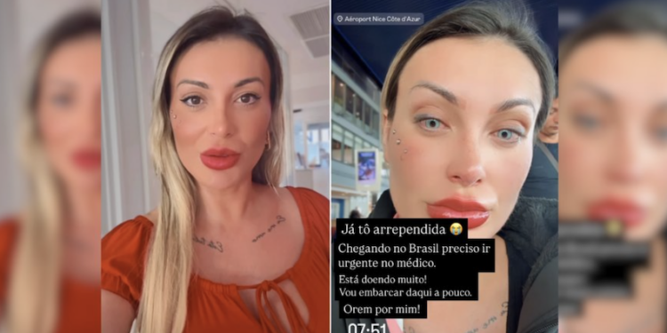 Procedimento para mudar a cor dos olhos é perigoso! Imagem: Instagram Andressa Urach
