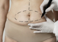Cirurgia bariátrica na gravidez é perigosa para o bebê. Foto: FreePik