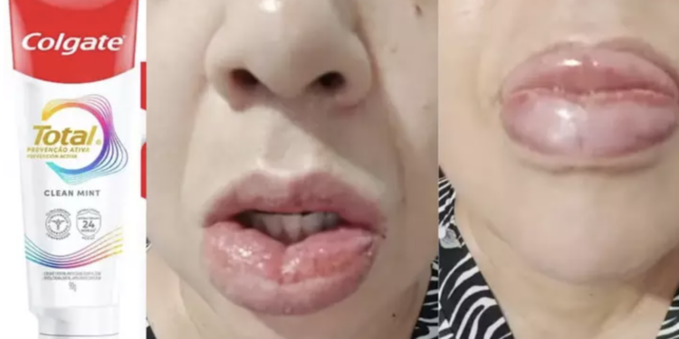 Entenda as reações adversas que o creme dental está causando. Foto: Divulgação/Perfil Brasil
