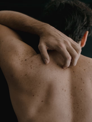 Câncer de pele pode ser prevenido. Foto: Unsplash