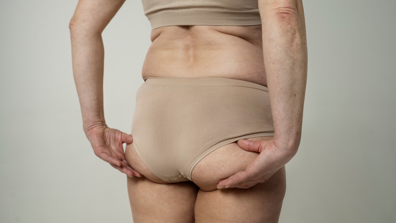 lipedema