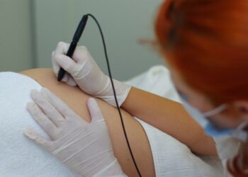 As melhores maneira de remover estrias de seu corpo