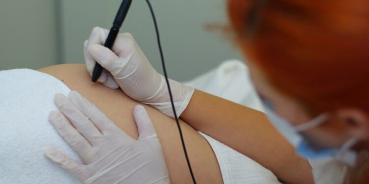 As melhores maneira de remover estrias de seu corpo