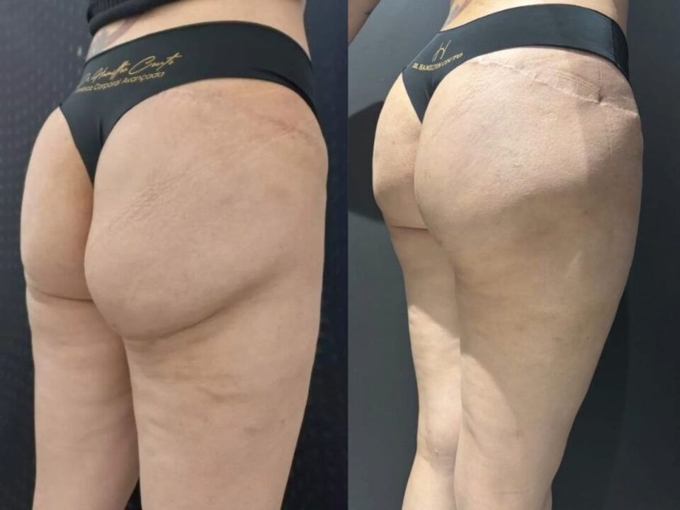 No antes e depois apresentado pelo médico é possível notar a diferença na assimetria dos glúteos com o uso do PMMA. Foto: Divulgação 