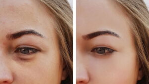 Terapia natural que reduz o inchaço da região dos olhos rapidamente