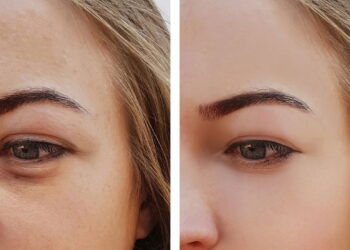 Terapia natural que reduz o inchaço da região dos olhos rapidamente