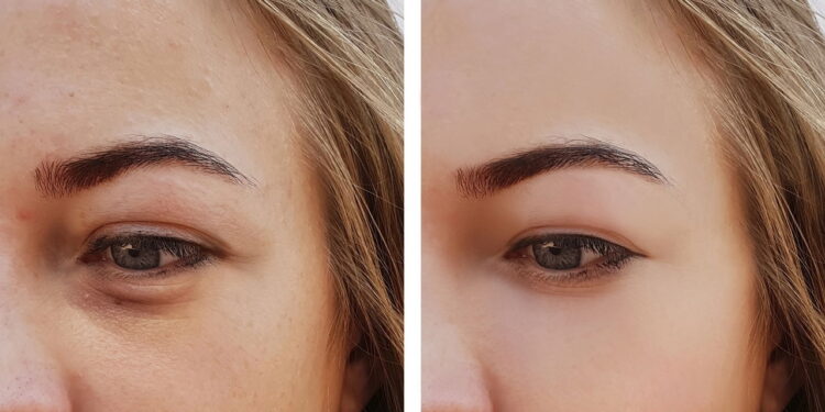 Terapia natural que reduz o inchaço da região dos olhos rapidamente