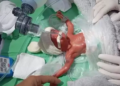 Bebê de apenas 750g tem alta. Foto: Reprodução