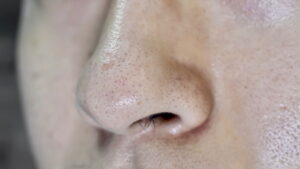 As melhores dicas para evitar a acne em sua pele