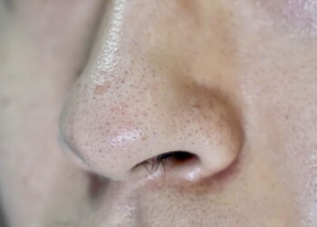 A melhor rotina de skincare para peles oleosas