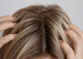 Como se livrar da caspa? Foto: FreePik