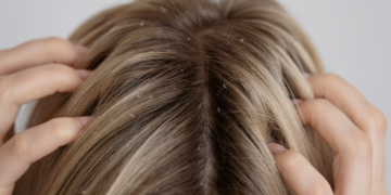 Como se livrar da caspa? Foto: FreePik