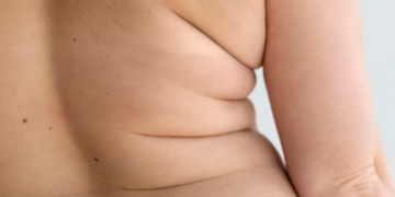Obesidade responde por mais de um terço dos atendimentos médicos em adultos. Foto: FreePik