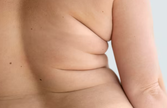 Obesidade responde por mais de um terço dos atendimentos médicos em adultos. Foto: FreePik