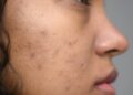 Como lidar com a acne de forma eficaz e natural