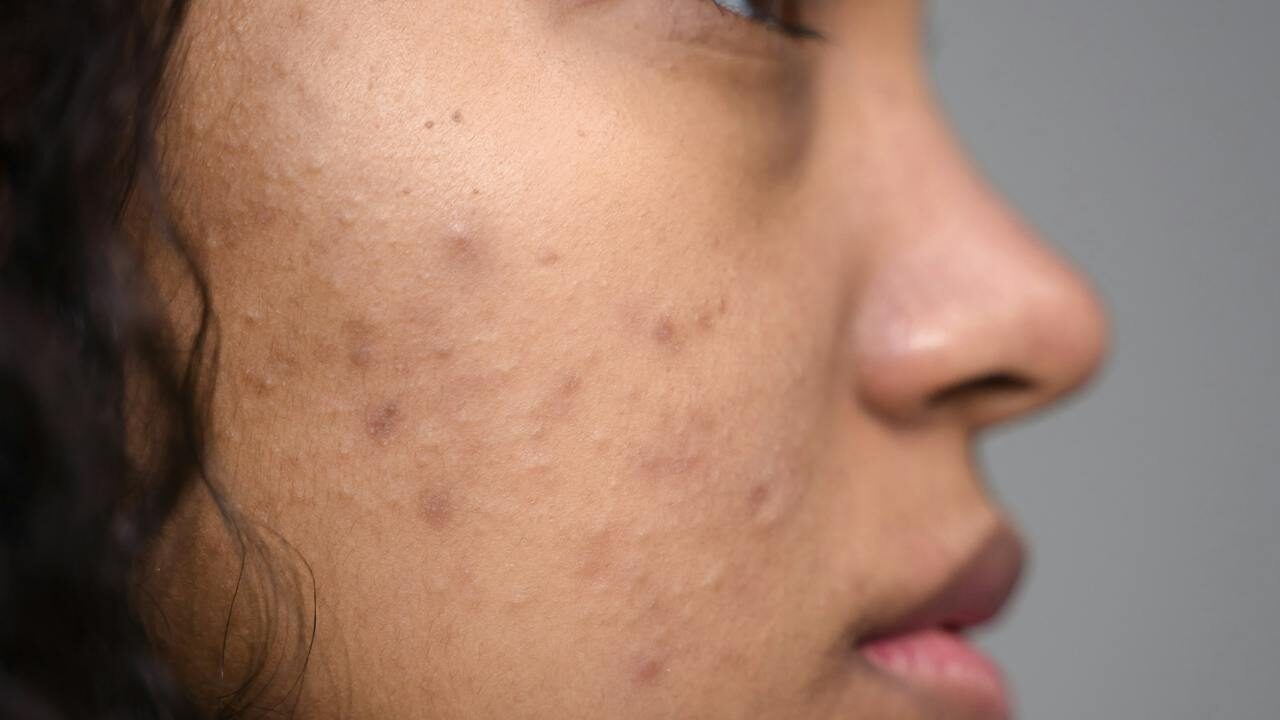 A importância da limpeza facial para evitar as acnes