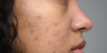 Como lidar com a acne de forma eficaz e natural