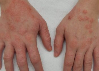 As dicas mais simples para prevenir a dermatite