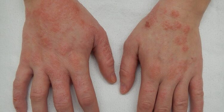 As dicas mais simples para prevenir a dermatite