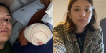 Menino brasileiro tem dedos amputados