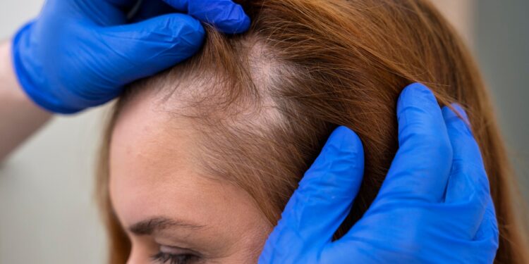 canetas emagrecedoras causam queda de cabelo