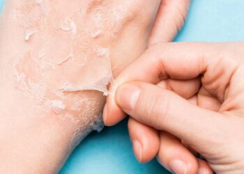 Como acalmar a pele queimada e hidratar profundamente