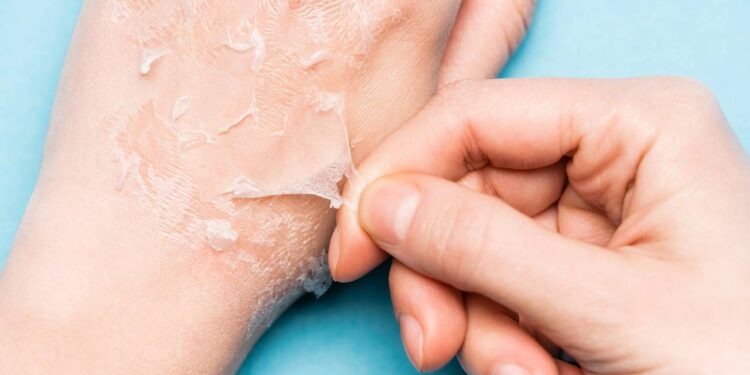 Como acalmar a pele queimada e hidratar profundamente