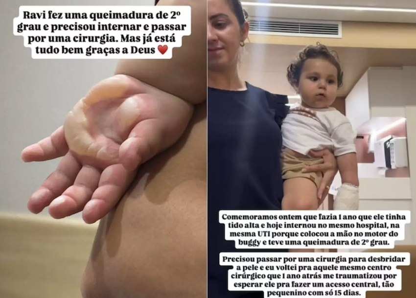 Filho de Viih Tube sofre queimaduras; veja quais são os acidentes domésticos mais comuns com crianças. Foto: Reprodução