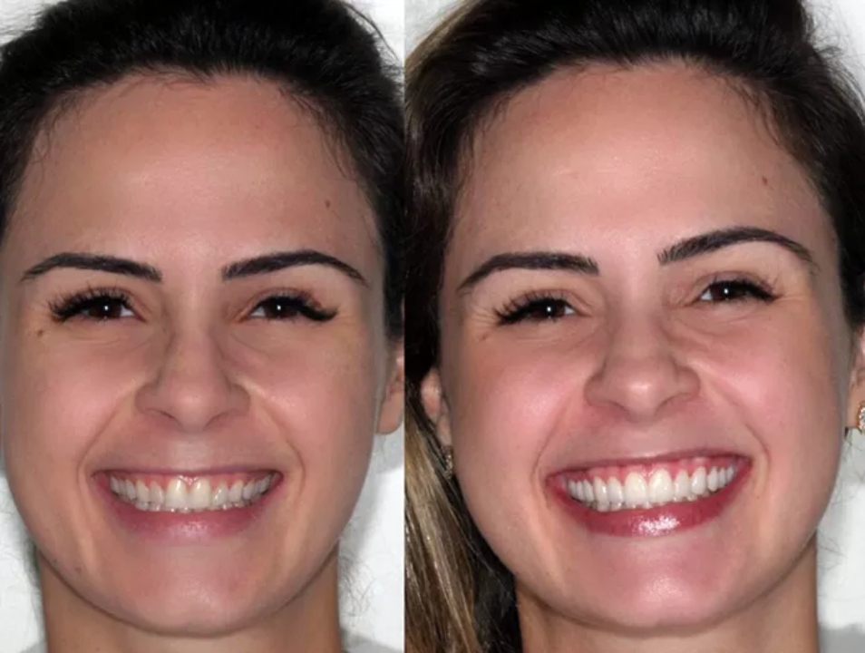 Ana Paula Renault dentes