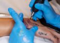 Remoção de tatuagens