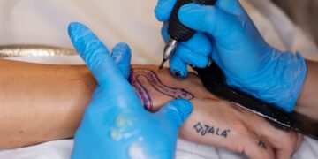 Remoção de tatuagens