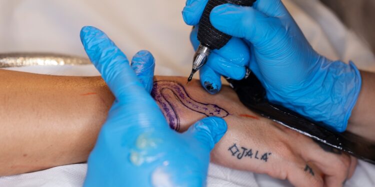 Remoção de tatuagens
