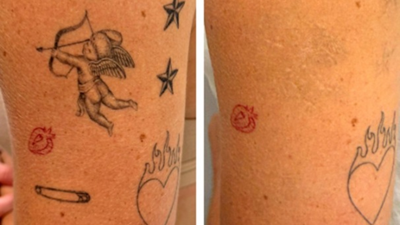 Remoção de tatuagens