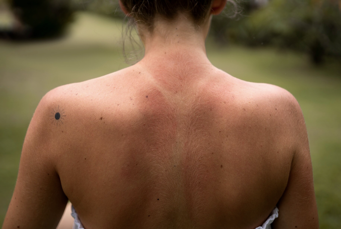 Pintas, manchas e sinais: entenda por que aparecem. Foto: FreePik