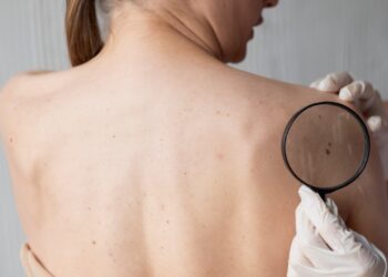 Regra do ABCDE: o guia simples para observar sinais suspeitos na pele - Crédito: FreePik
