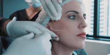 Acompanhe de pertinho como é a aplicação do botox para aliviar a dor do bruxismo. Foto: reprodução.