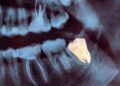 dente-do-siso