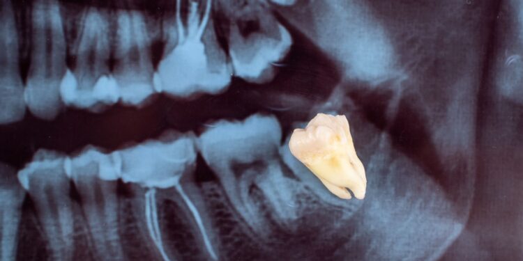dente-do-siso