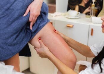 Lipedema