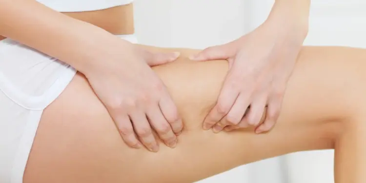 Lipedema no pós-parto: Como tratar com a alimentação